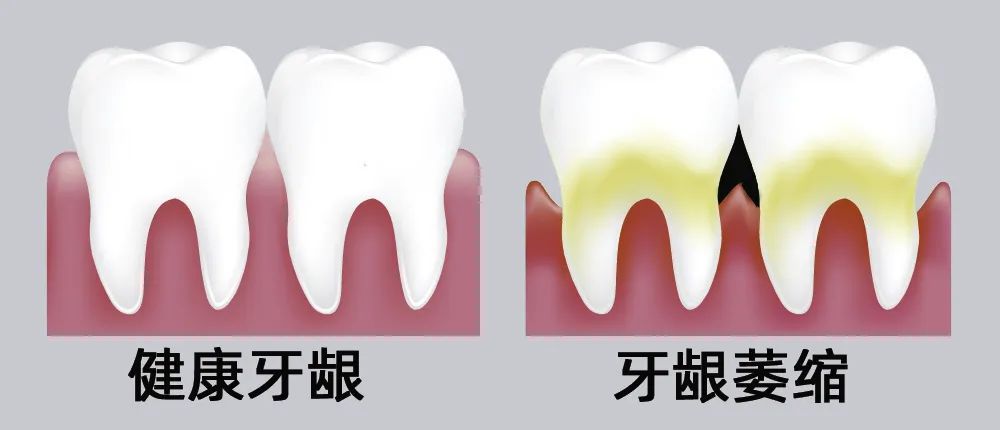 牙縫大露出“黑三角”，既塞牙又難看！還能恢復(fù)嗎？